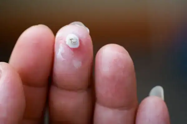 Image of white wart before cryopen treatment Derby