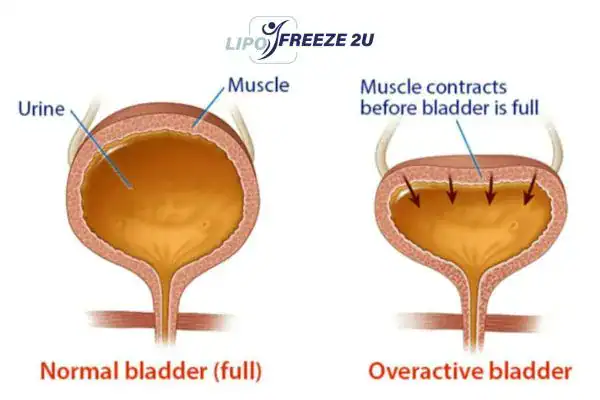 diagram of overactive bladder treatment Derby
