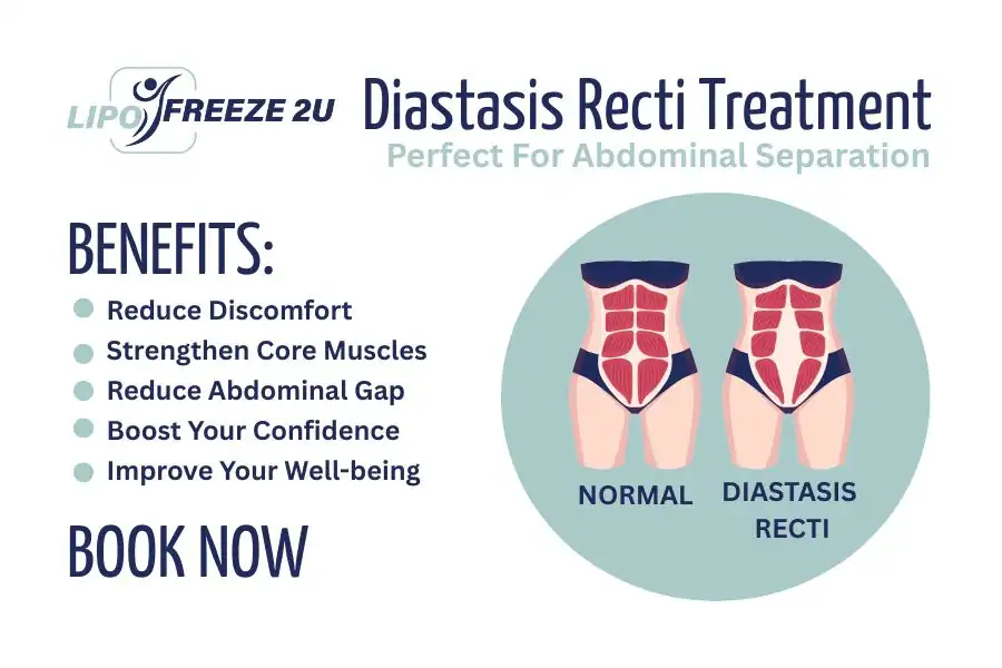Benefits of body toning treatment Derby for Diastasis recti