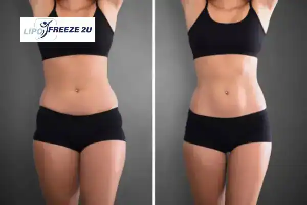 How Can LIPO FREEZE 2U Support Your Post-Pregnancy Body Recovery Derby?
