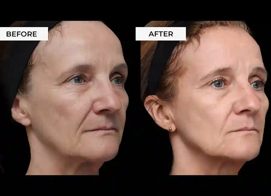 How Many RF Microneedling Sessions Will You Need to See a Difference Derby?