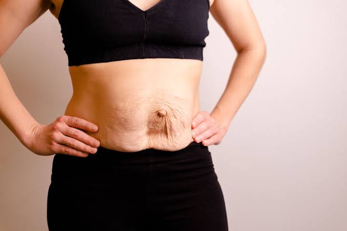 Is Surgery Really the Only Way to Repair Diastasis Recti Derby?