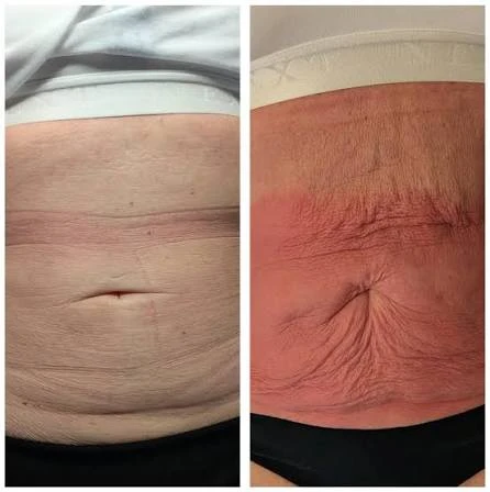 How Does RF Microneedling Improve Crepey, Thin and Uneven Skin Texture Derby?