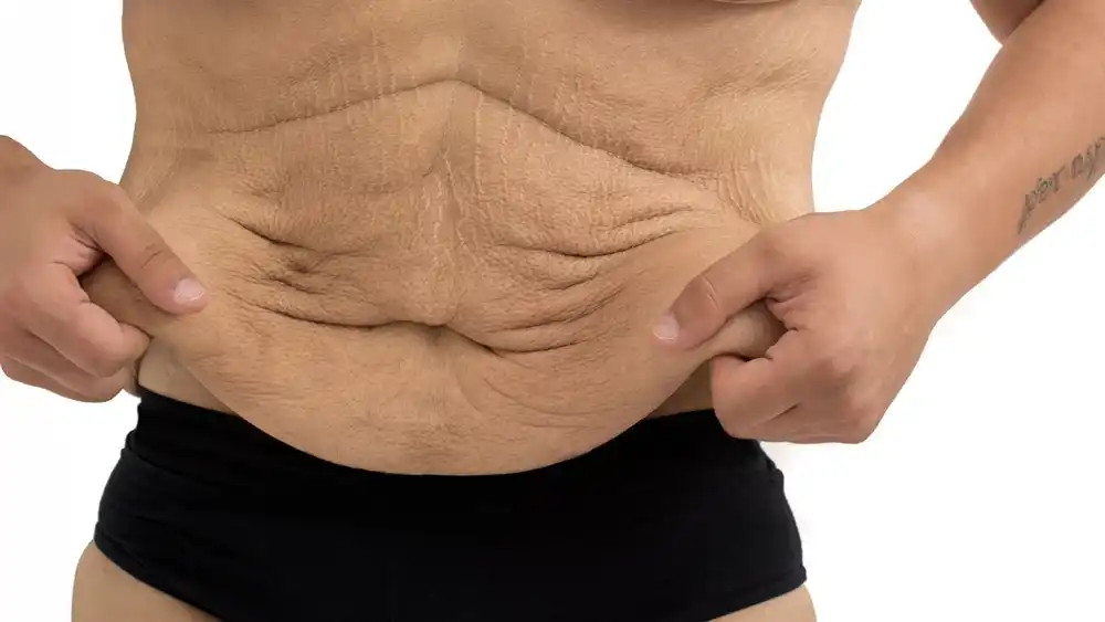 Why Does Weight Loss Medication Leave Some People With Loose or Sagging Skin Derby?